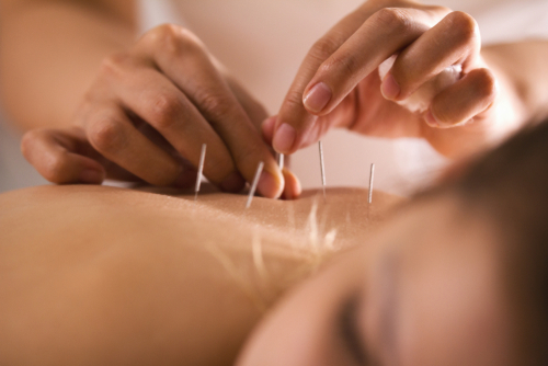 hermosa-beach-acupuncture-treatment