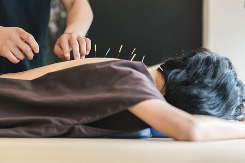 Acupuncture-Treatment-in-Manhattan-Beach